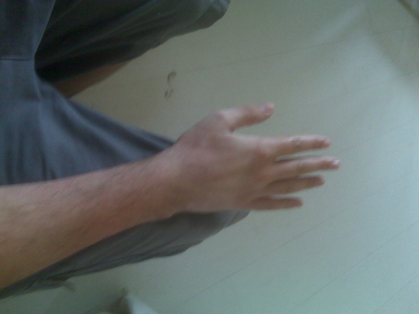 My arm after cast came off
